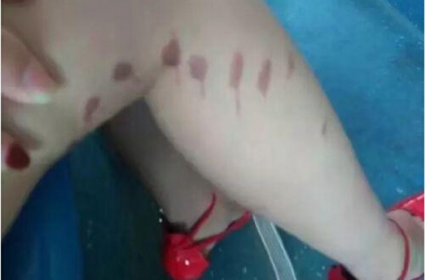可怕!多名短裙女生被泼不明液体 刺痛留疤或为强酸