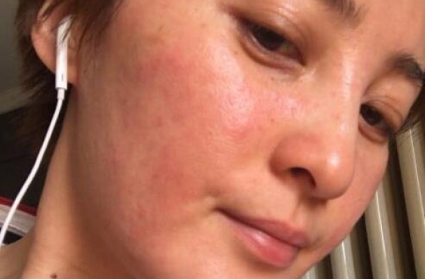蒋勤勤皮肤严重过敏 脸部浮肿泛红太吓人