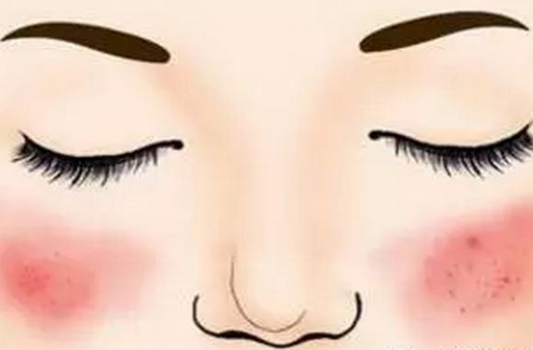 激素脸皮肤薄脸容易红怎么办？激素脸用什么曾厚角质层